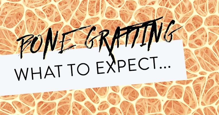 You are currently viewing What to Expect When Expecting (..A Bone Graft)