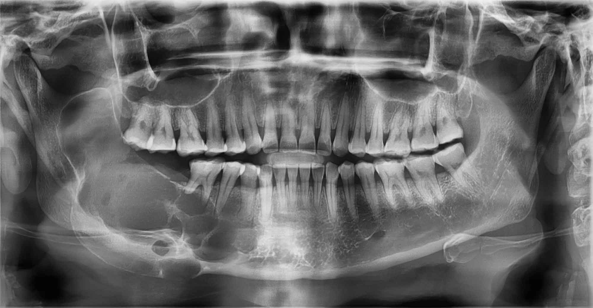 Average Cost Of Panoramic X Ray