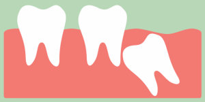 Read more about the article What Is A Wisdom Tooth