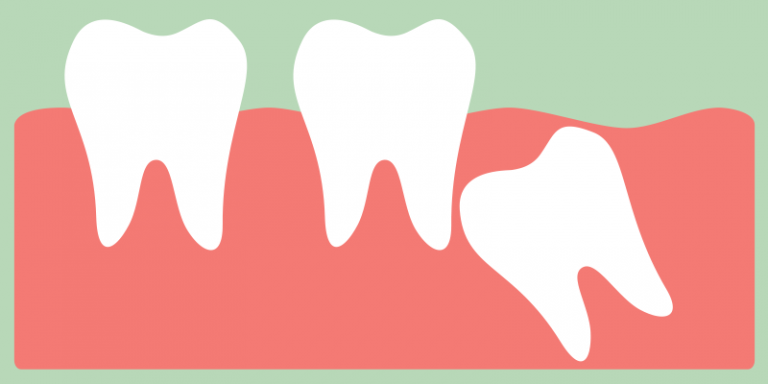 You are currently viewing What Is A Wisdom Tooth